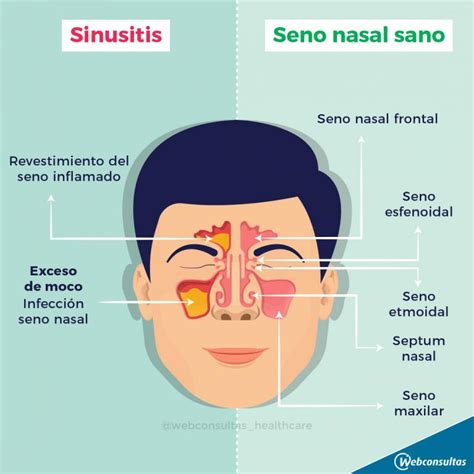 sintomas de sinusitis